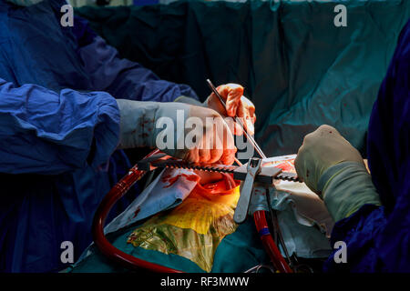 A surgeon performs coronary artery bypass grafting open heart surgery. Stock Photo