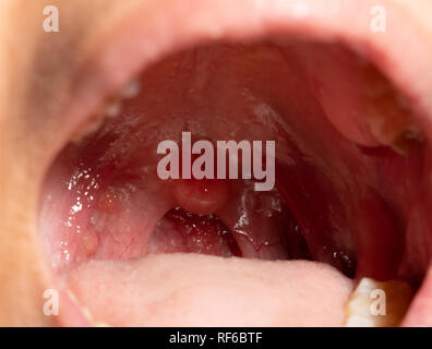 Canker Sore On Uvula