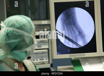 Surgery, correction of a foot, X-ray picture Stock Photo