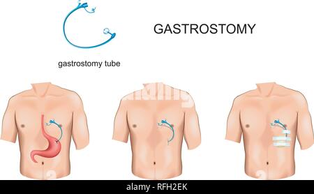 vector illustration of gastrostomy tube with esophageal obstruction Stock Vector