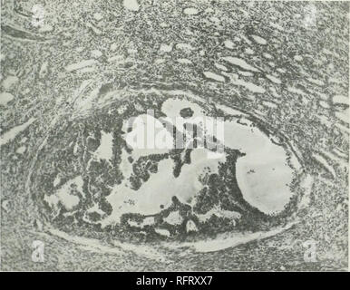 . Carcinoma of the thyroid in the salmonoid fishes. Cancer; Goiter; Thyroid gland; Trout. Fio. 43.—Section showing intensive nodular growth with concentric compression of the surrounding tumor tissue. X40. Fig, 44.—Section showing individual follicles of more malignant type infiltrating surrounding tumor tissue. X130.. Fk;. 45.—Section showing encapsulated nodule of papillar type lying in tumor tissue of alveolar type. X94.. Please note that these images are extracted from scanned page images that may have been digitally enhanced for readability - coloration and appearance of these illustratio