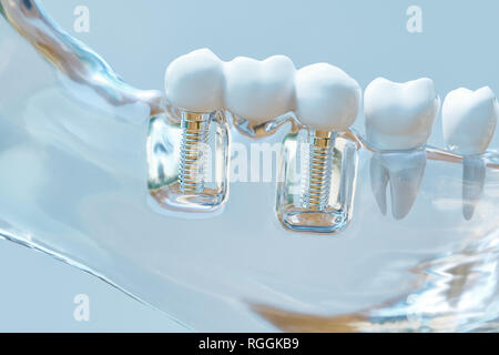 Tooth human implant - 3D Rendering Stock Photo