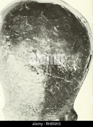 . The brain in hominid evolution. Human evolution; Brain; Fossil hominids. Figure 24: Outer and inner views of the calotte of Homo erectus I from Trinil, Indonesia. The capacity of the calvaria, long regarded as 900, 935, or even 950 c.c, has been redetermined as 850 c.c. Homo erectus I of Trinil, Indonesia The original discovery of a hominid in Java late in the last century was made by E. Dubois. The first skull was represented by little more than the calotte, or roof, of the braincase, but sufficient of the side walls of the vault and of the occipital squamous portion were preserved to enabl Stock Photo