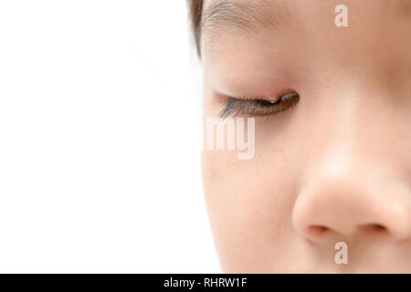 Close up of asian little girl one eye infection isolated on white background, eyelid abscess, stye, hordeolum. Concept of health, disease Stock Photo