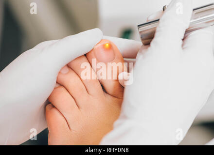 laser treatment on toenail, fungal infection on the toenails Stock Photo