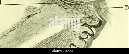 . Pathology and bacteriology [electronic resource]. Ophthalmology; Eye;  Eye; Bacteriology; Ophthalmology; Eye; Bacteriology; Eye. THE CORNEA 559  Tertiary syphilis rarely affects the lids and conjunctiva. Occasionally  gummatous ulcers may form on the