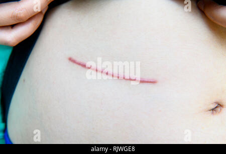 Stomach of a woman showing the operation scars from a laparoscopy ...