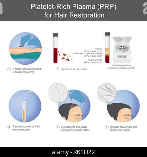 Stimulation of hair growth by using blood from service recipients through the process of separating platelet rich plasma, To be injected onto the scal Stock Vector