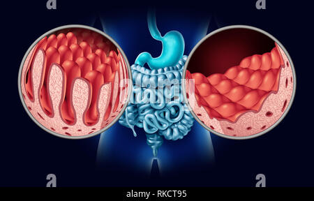 Celiac or coeliac disease of the intestine anatomy medical concept with ...