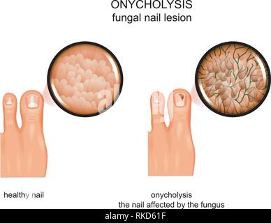 vector illustration of onycholysis, fungal nail infection, treatment ...