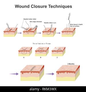 A wound is a type of injury which happens relatively quickly in which ...