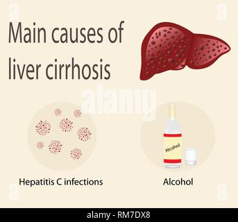 Main causes of liver cirrhosis hepatitis C infection  and alcohol vector illustration  infographics Stock Vector