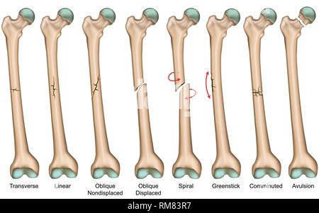 Types of bone fracture. Femur bone. Vector illustration Stock Vector ...