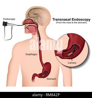 Transnasal endoscopy medical vector illustration on white background Stock Vector