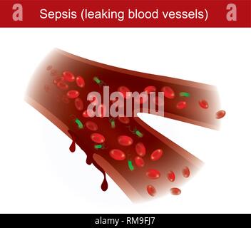 When the body has immune response to bacterial infections, causing inflammation and leaking blood vessels in the body. Stock Vector