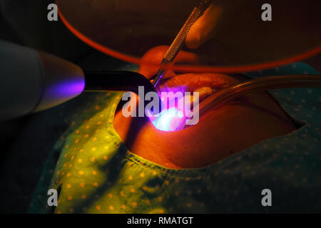 Dentist use a dental curing light (blue wand) to polymerization of light cure resin based composite (white filling) in patient mouth Stock Photo