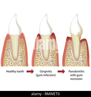 The stages of periodontitis disease vector illustration Stock Vector ...