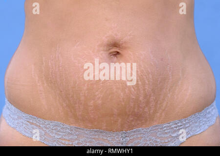 Woman displaying stretch marks on her abdomen after pregnancy caused by tearing of the dermis layer of the skin and showing as red discolorations, clo Stock Photo