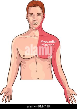 Vector illustration of a Heart attack pain location (Myocardial Infarction) Stock Vector