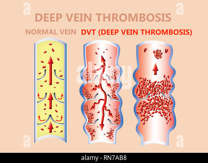 thrombosis. From Normal blood flow to Blood clot formation Stock Photo