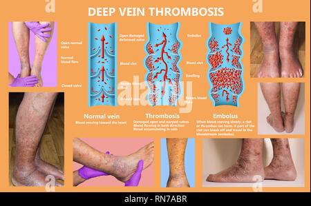 Economy class syndrome mechanism, deep vein thrombosis or DVT, Pulmonary Embolism, coronary thrombosis, diagram Stock Photo