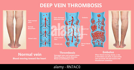 thrombosis. From Normal blood flow to Blood clot formation Stock Photo