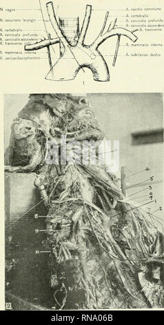 . The anatomical record. Anatomy; Anatomy. ANOMALOrS ORIGIN OF SUBCLAVIAN ARTERY 787 N. vagus A. vertebraiis- — — A. cervicalis profunda A. cervicalis ascenden A. transversa A. carotis commune A. vertebraiis A. cervicalis profunda A. cervicalis ascendens A. transversa colli. Fig. 1 Diagrammatic sketch of the actual arrangement. Fig. 2 Trachea and esophagus pulled forward, heart and aortic arch thrown toward the left; 1, transverse portion of the aortic arch; 2, descending aorta; 3, trachea and esophagus; 4, a. carotis communis dextra; 5, a. carotis communis sinistra; 6 a. subclavius sinistra;  Stock Photo