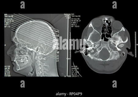 Head in computer tomography, CT image Stock Photo