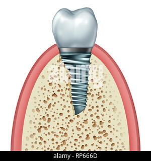 Dental Implant or endosseous tooth prosthetic inside the jaw bone and gum tissue with an orthodontic crown abutement and metal screw. Stock Photo