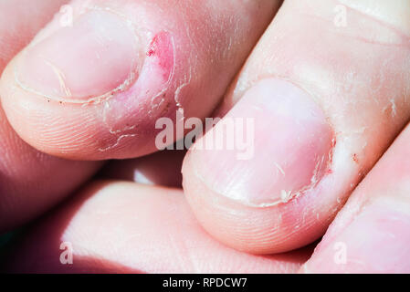Bitten skin on the fingers Stock Photo