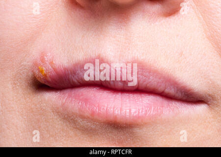 Herpes on the lip close up macro Stock Photo