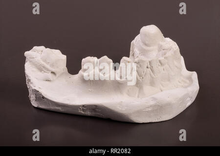 plaster cast of teeth with removable partial denture on a dark background Stock Photo