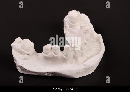 plaster cast of teeth with removable partial denture on a dark background Stock Photo