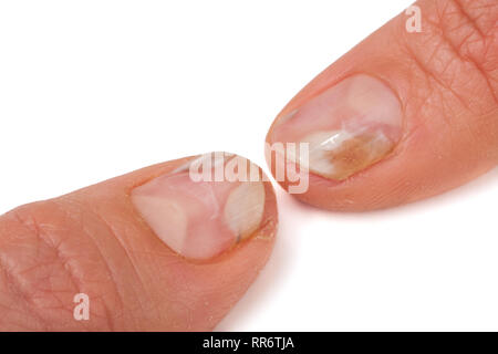 two fingers of the hand with a fungus on the nails isolated  white background Stock Photo