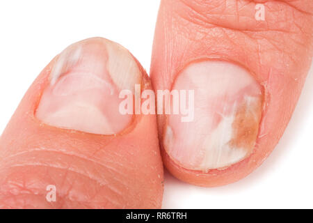 two fingers of the hand with a fungus on the nails isolated white background Stock Photo