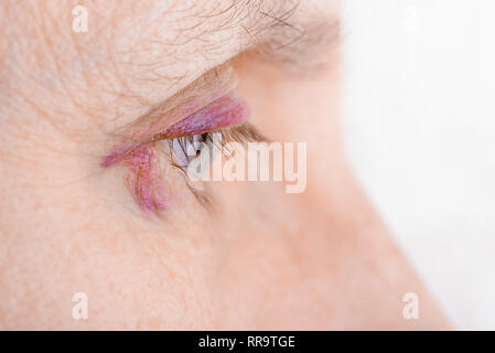 Woman's eye injured due to rupture of capillary, causing hematoma or bruising. It could also be conjunctivitis or other allergic eye inflammation Stock Photo