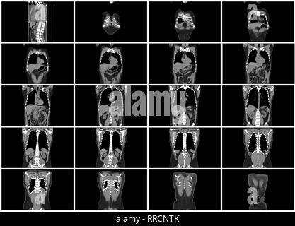 ct scan step set of body coronal view Stock Photo