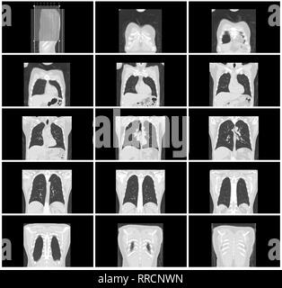ct scan step set of body lung coronal view Stock Photo