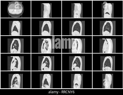 ct scan step set of body lung sagittal view Stock Photo