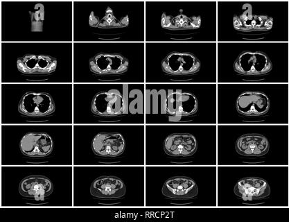ct scan step set of upper body abdomen top view Stock Photo