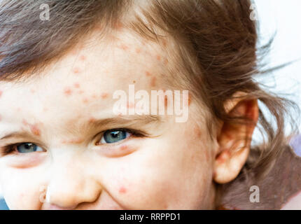 Close up shot of varicella virus or chicken pox bubble rash and blister on babys face with crust - Dermatology concept Stock Photo