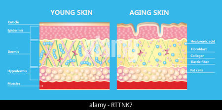 The diagram of younger skin and aging skin Stock Photo