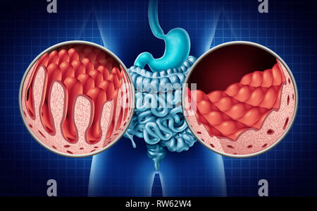 Coeliac Disease Or Celiac Disease. Small Bowel Showing Coeliac Stock ...