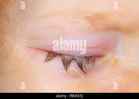 Swollen and sticky eyelid of a small baby with conjunctivitis Stock Photo