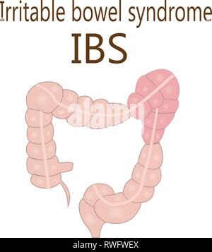 Irritable bowel syndrome (IBS) in a large intestine vector illustration isolated on a white background Stock Vector