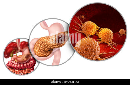Pancreas cancer anatomy diagram and pancreatic malignant tumor concept as a medical symbol of a digestive gland body part with a microscopic. Stock Photo