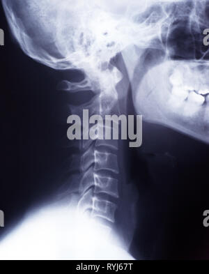 X-ray of neck and cervical spine, lateral, side view Stock Photo