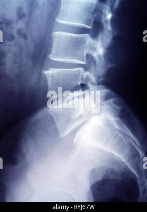 Lumbar spine x-ray film lower thorax Stock Photo