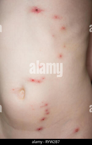 Molluscum contagiosum on the skin of a child Stock Photo - Alamy