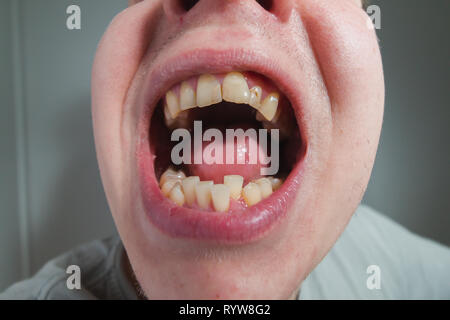 European male open mouth crooked yellow teeth dry lips Stock Photo